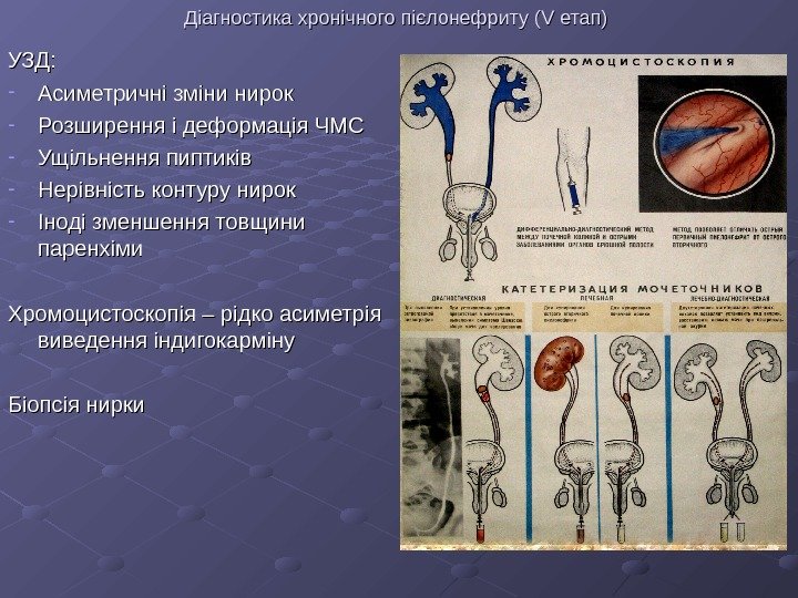   Діагностика хронічного пієлонефриту ( VV етап) УЗД: - Асиметричні зміни нирок -